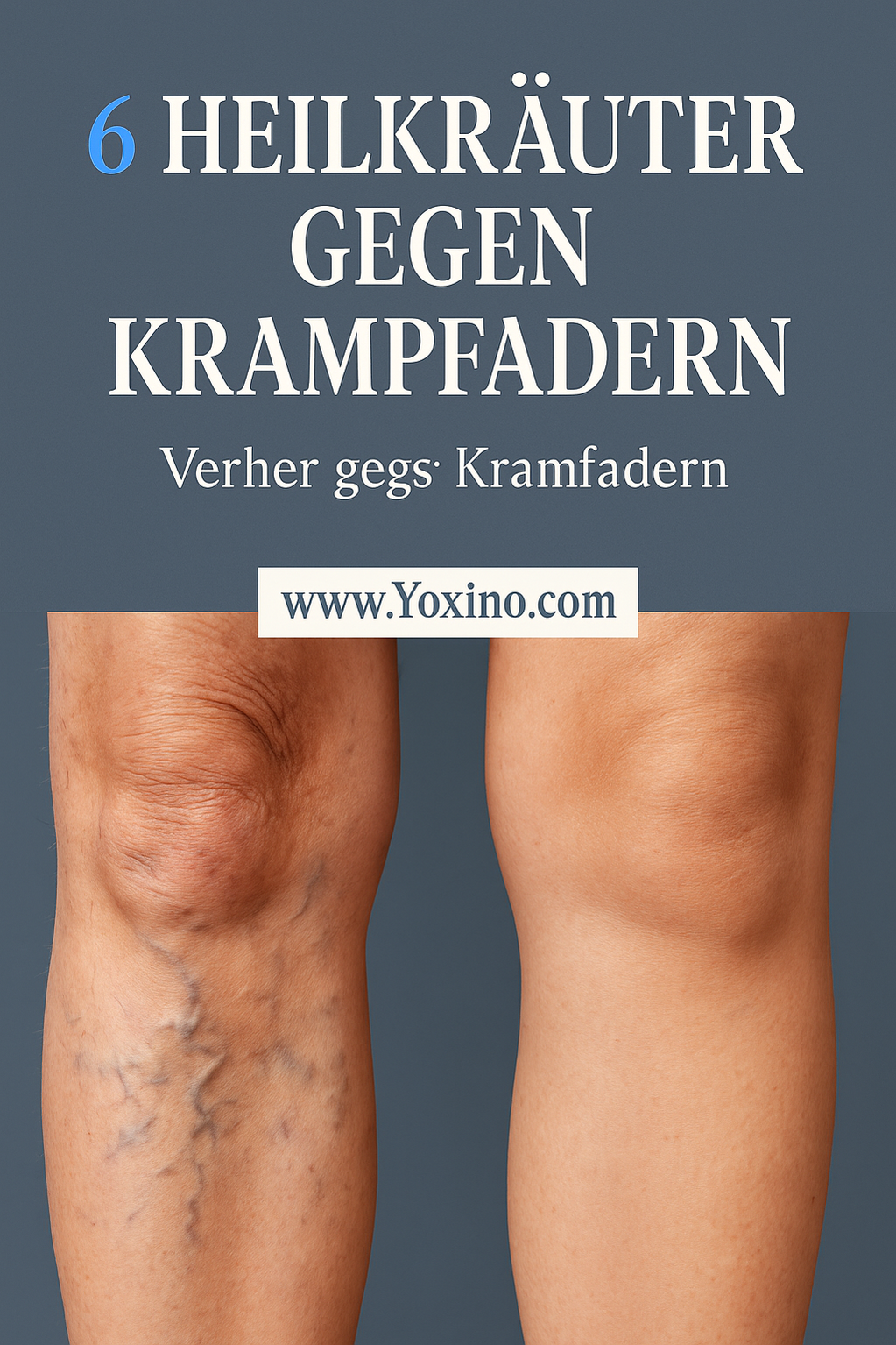 Hausmittel gegen Krampfadern